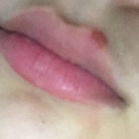 Wunde An Der Lippe Wie Bekomme Ich Es Weg Gesundheit