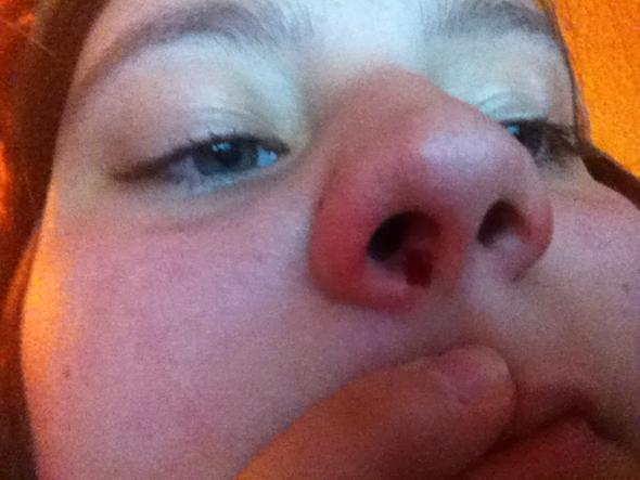 Wunde An Der Nase Blutet Was Jetzt Blut Wunde An Der Nase Blutet Was Jetzt Blut