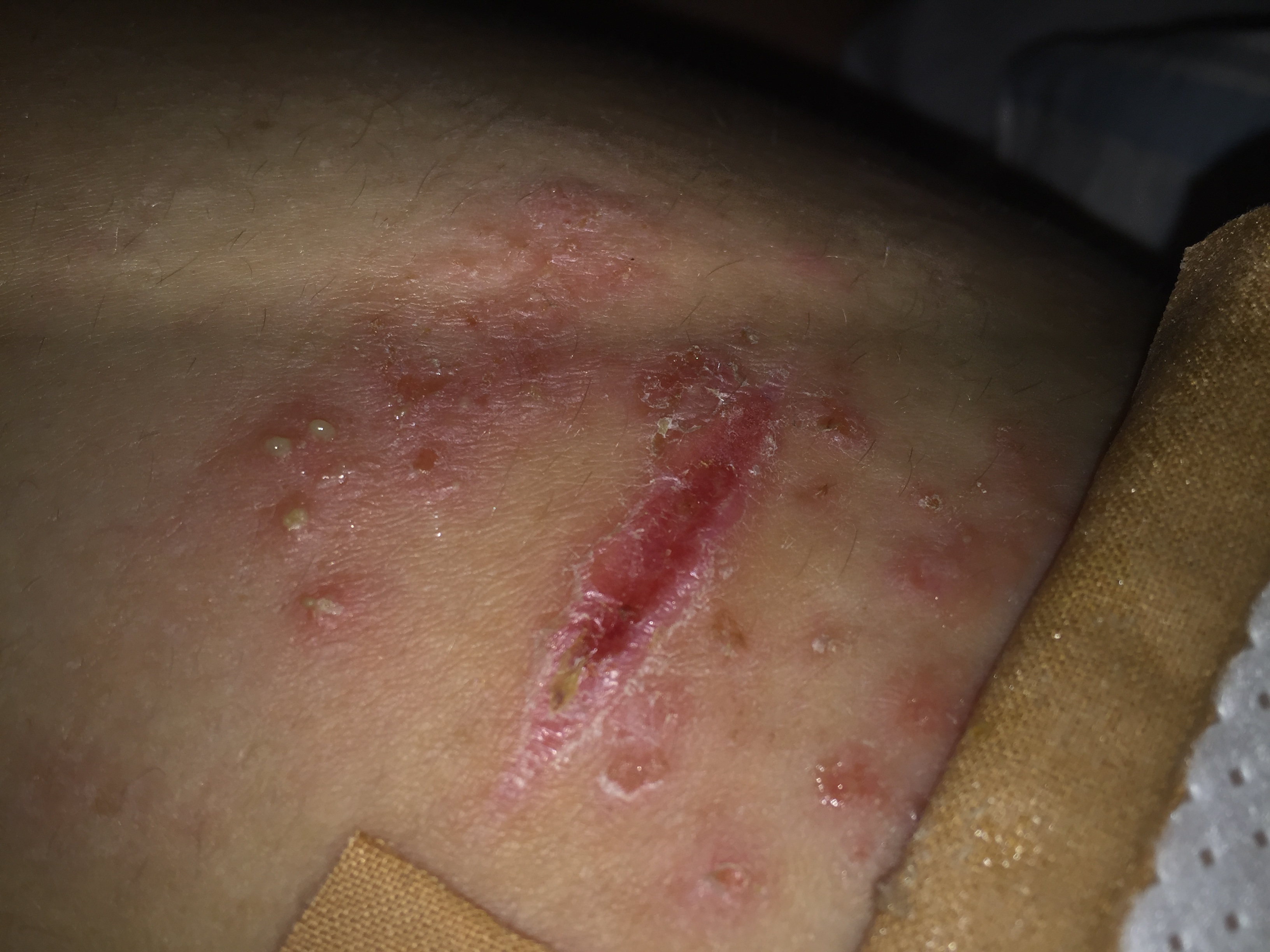Pickel Mit Blut Und Eiter Gefüllt