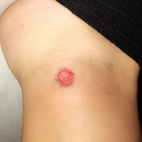Wunde Heilt Einfach Nicht Mit Bild Blut Verletzung Heilung Wunde Heilt Einfach Nicht Mit Bild Blut Verletzung Heilung
