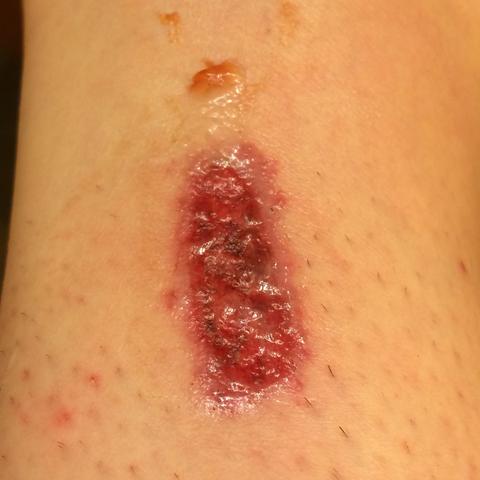 Wunde Heilt Nicht Was Kann Man Noch Tun Blut Verletzung Wunde Heilt Nicht Was Kann Man Noch Tun Blut Verletzung