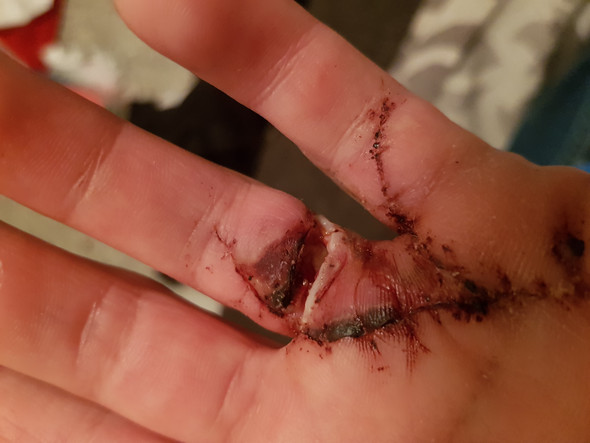Wunde Nach Op Wieder Offen Ist Es Schlimm Gesundheit Und Medizin Operation Hand Wunde Nach Op Wieder Offen Ist Es Schlimm Gesundheit Und Medizin Operation Hand