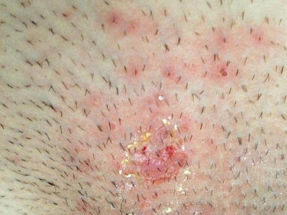 wunde stelle im intimbereich herpes