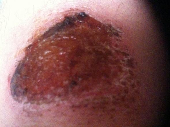 So sieht es jetzt aus - (Medizin, Verletzung, Knie)