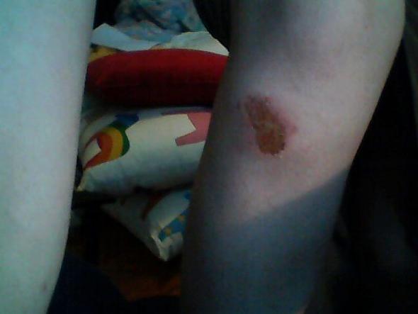 Wunde Wo Sich Kruste Bildet Sieht Das Normal Aus Gesundheit Korper Wunde Wo Sich Kruste Bildet Sieht Das Normal Aus Gesundheit Korper