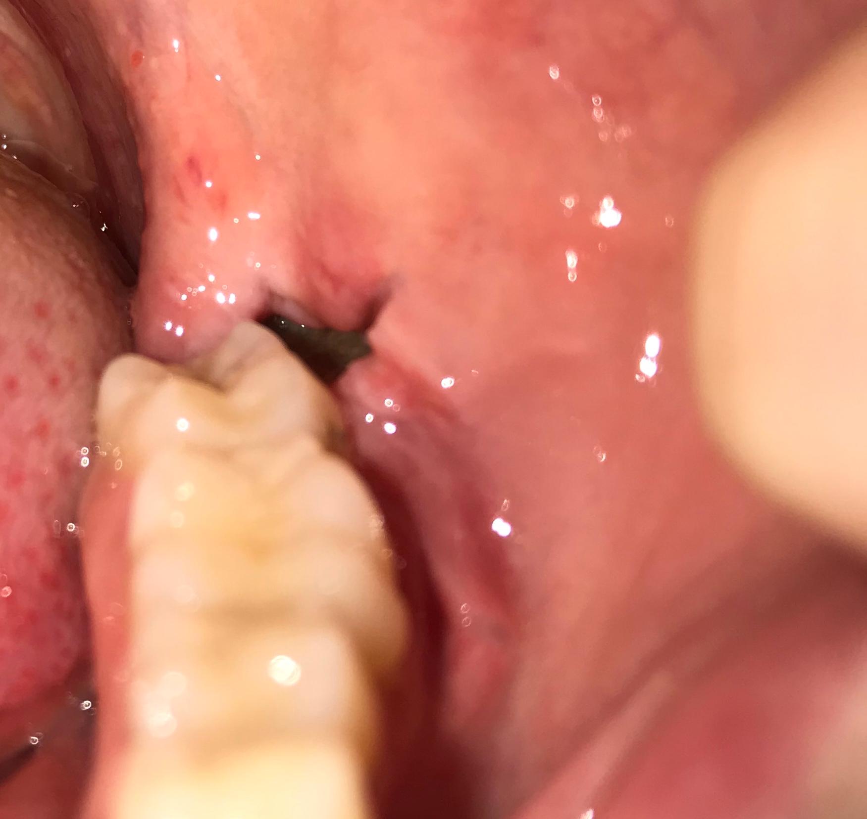 Wunde/Loch nach Weisheitszahn OP? (Gesundheit und Medizin, Zähne, Weisheitszähne) Wunde/Loch nach Weisheitszahn OP? (Gesundheit und Medizin, Zähne, Weisheitszähne)