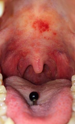 Gaumen - (Zahnarzt, Entzündung, Infektion)