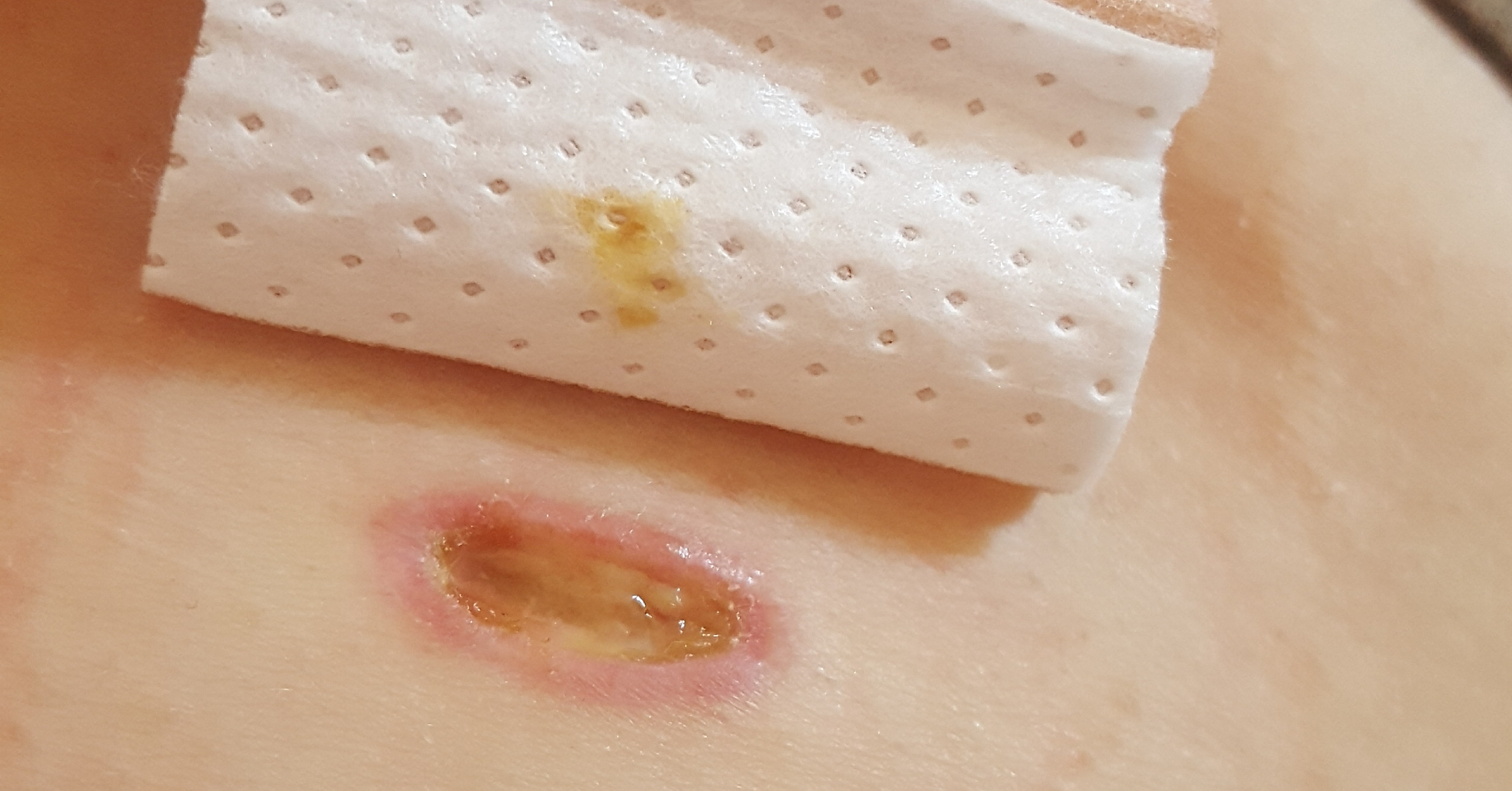 Wundheilungsstörung nach GallenblasenOP (Ärzte wollen nix machen) ? (Medizin, Operation Wundheilungsstörung nach GallenblasenOP (Ärzte wollen nix machen) ? (Medizin, Operation