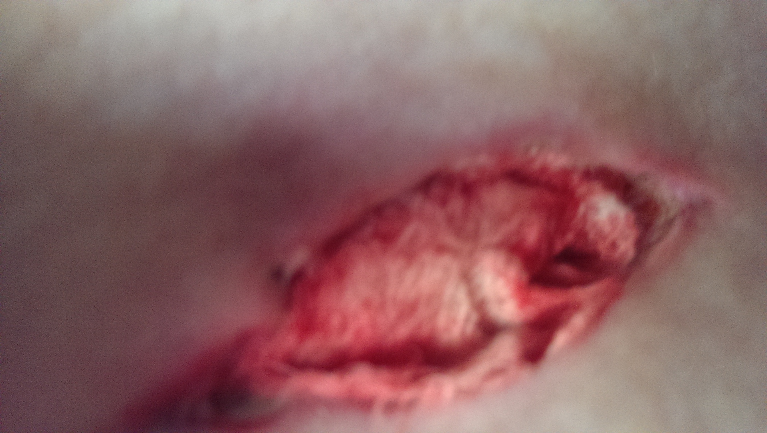 Wundversorgung Nach Fistel Operation Fragen Abszess Wundversorgung Nach Fistel Operation Fragen Abszess