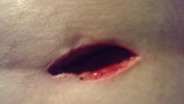 nach Fistel Operation! Fragen (Abszess) nach Fistel Operation! Fragen (Abszess)