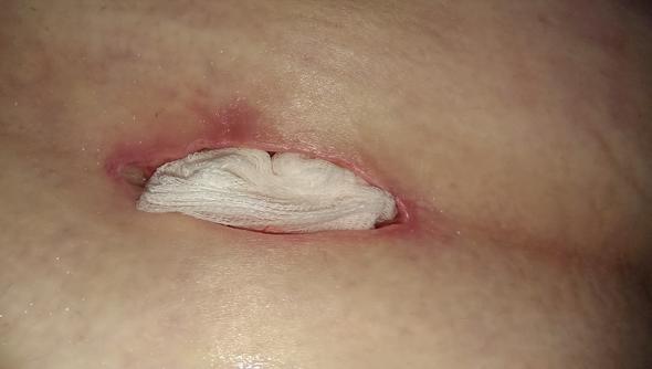 Wundversorgung Nach Fistel Operation Fragen Abszess Wundversorgung Nach Fistel Operation Fragen Abszess