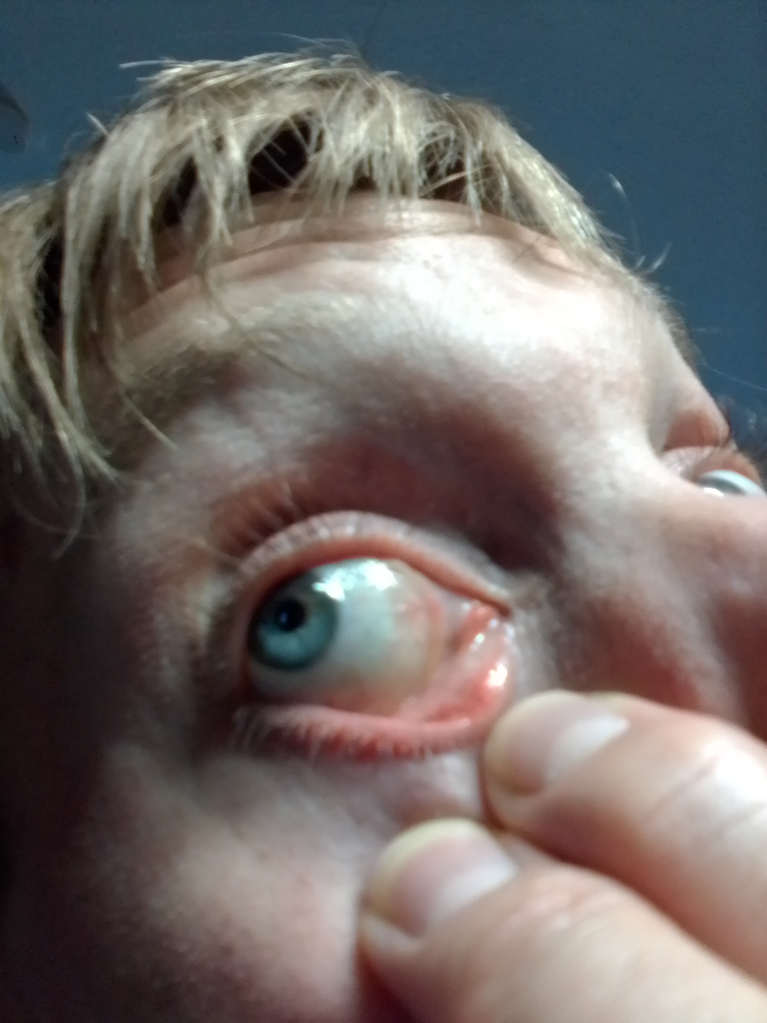 Wurm Im Auge Wurm Im Auge