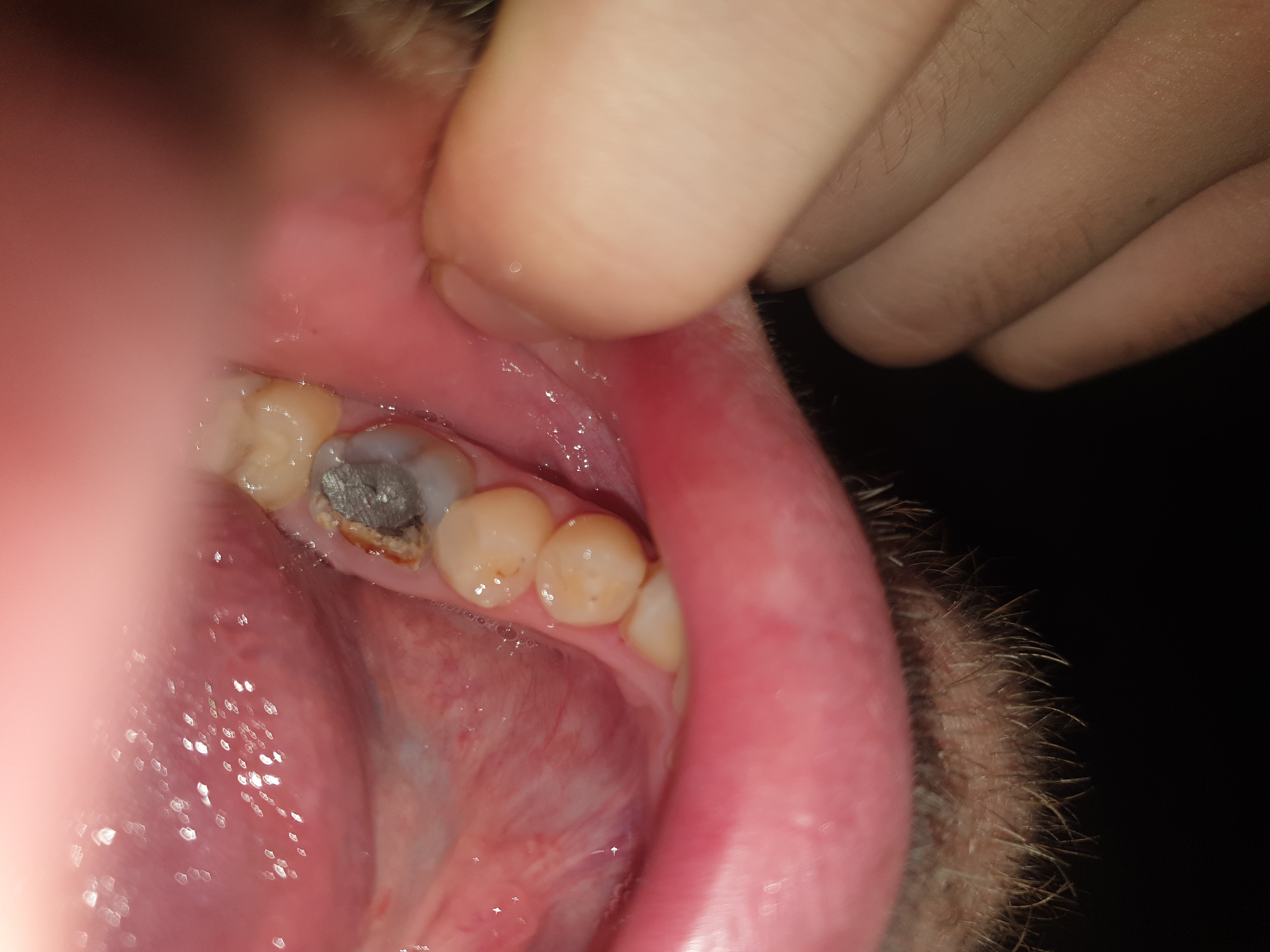 Wurzelbehandelter Zahn Zerbrochen Zahne Bruch