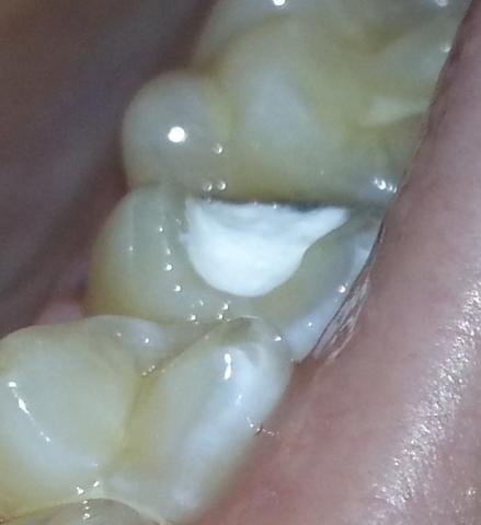 Rausgefallen wurzelbehandlung provisorische füllung Zahnfüllung herausgefallen
