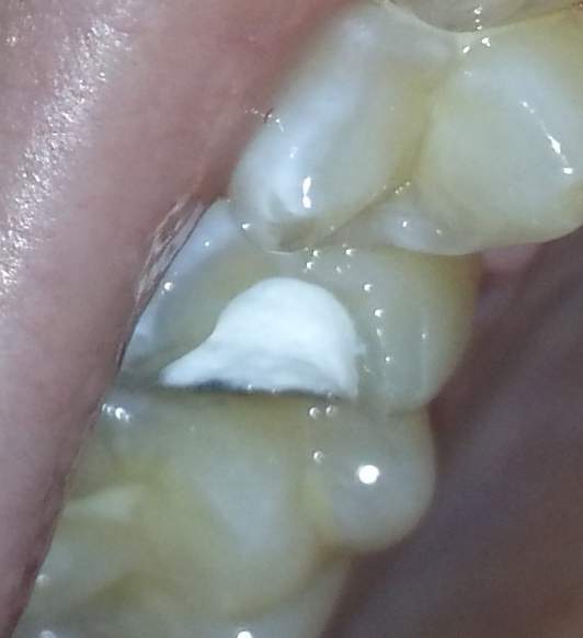 Wurzelbehandlung. Provisorische Füllung evtl Nachbessern? (Medizin, Schmerzen, Zähne)