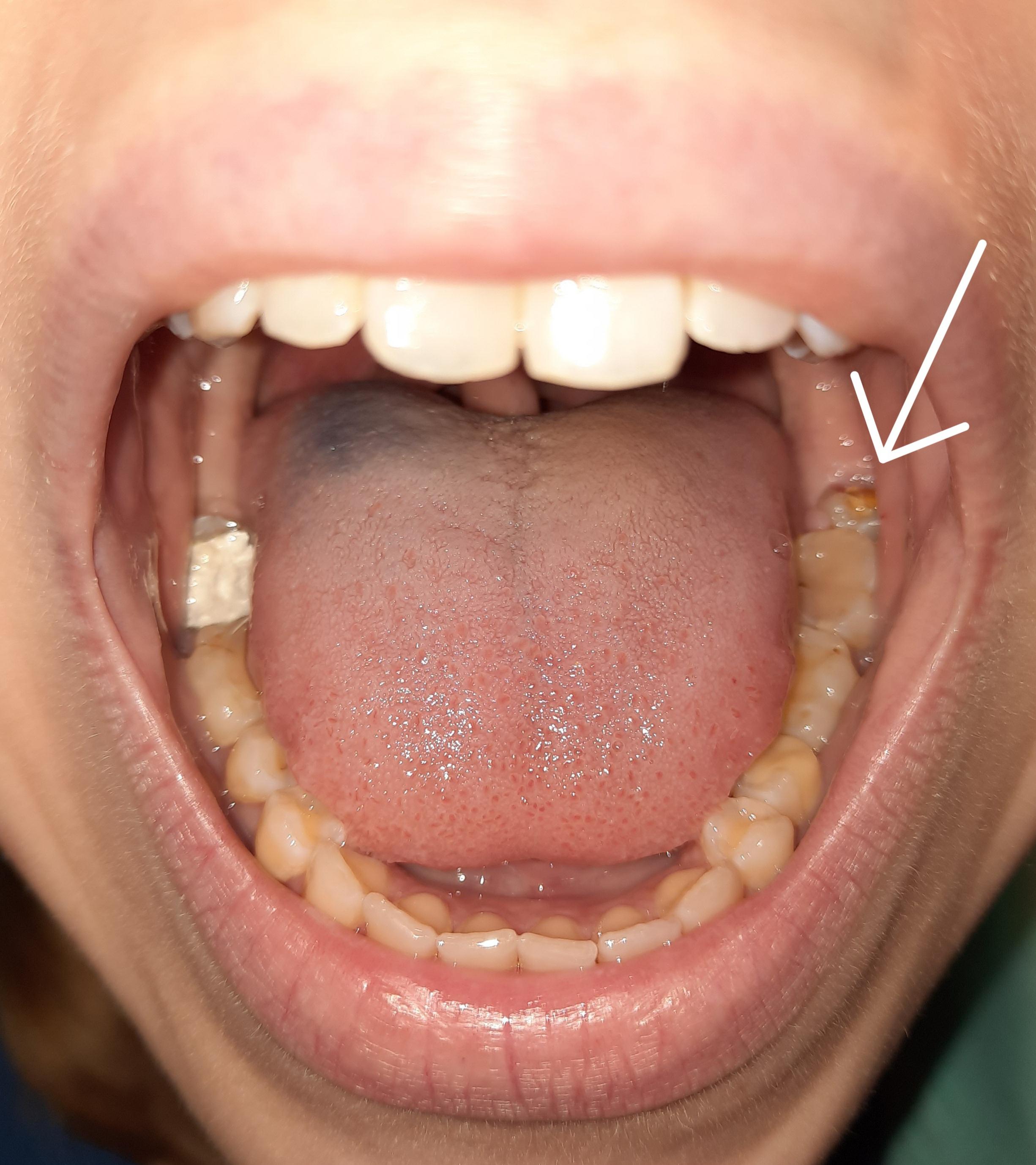 Wurzelbehandlung Schmerzen Zahne Wurzelbehandlung Schmerzen Zahne