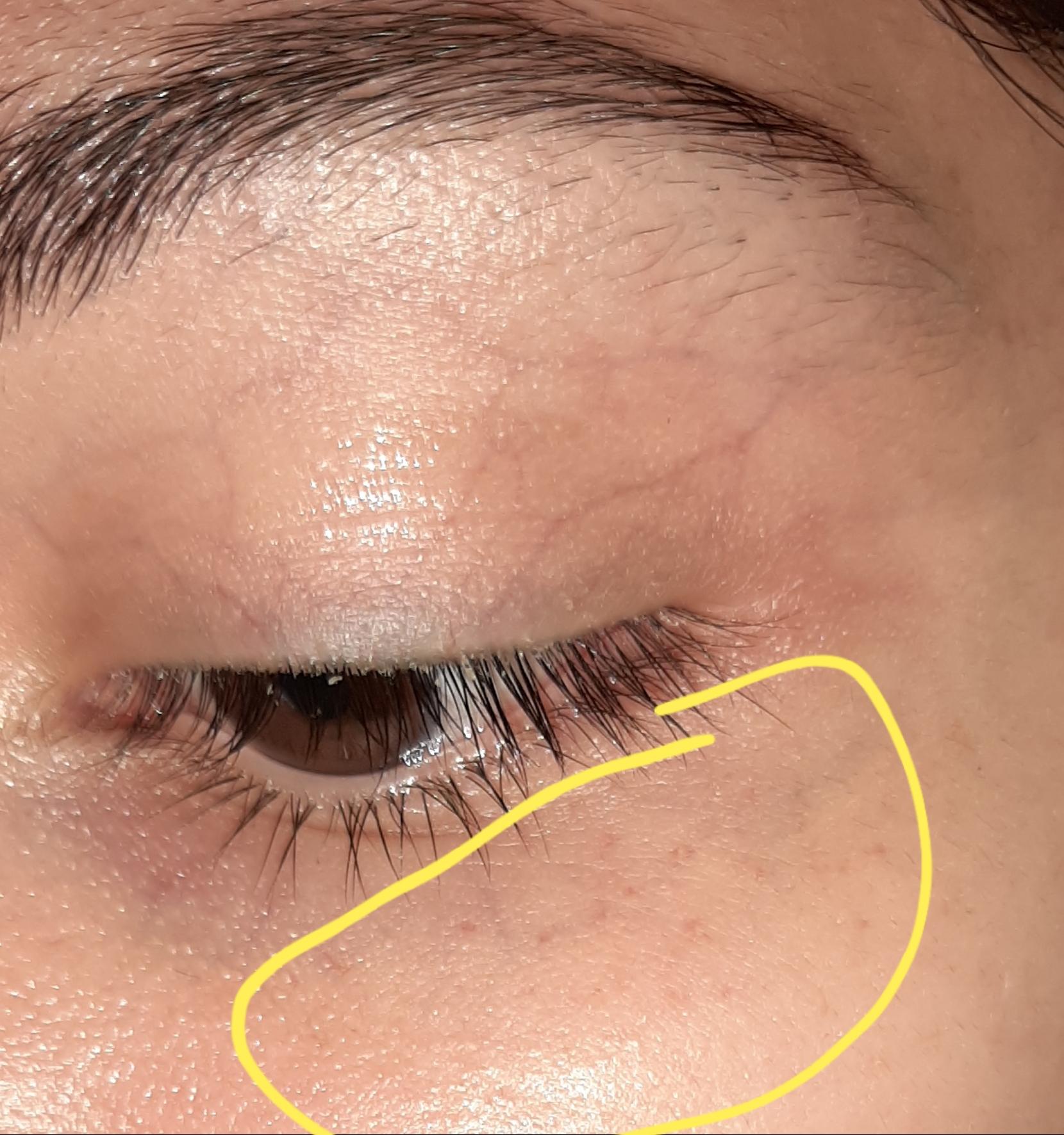 Warum Habe Ich Kleine Rote Punkte Unter Meinen Augen Bekommen Haut Warum Habe Ich Kleine Rote Punkte Unter Meinen Augen Bekommen Haut