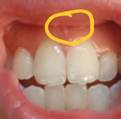 Weisser Punkt Am Zahnfleisch Zahnmedizin