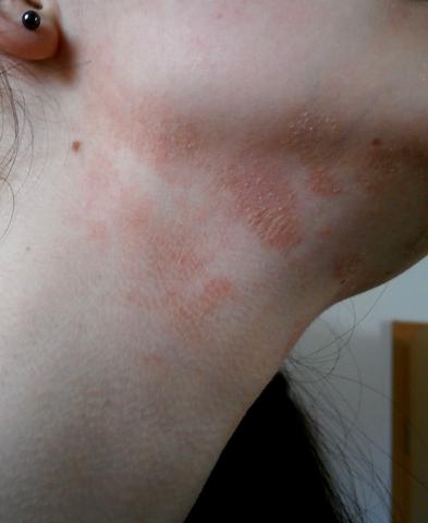 Xwas Sind Das Fur Flecken Haut Rot Ursache Xwas Sind Das Fur Flecken Haut Rot Ursache