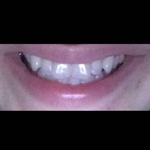 Zahne Abschleifen Wie Geht Das Zahnarzt Zahne Abschleifen Wie Geht Das Zahnarzt