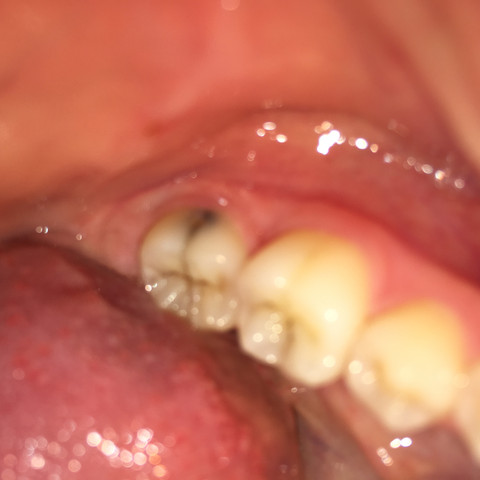 betroffener Zahn  - (Zähne, Zahnarzt, bohren)