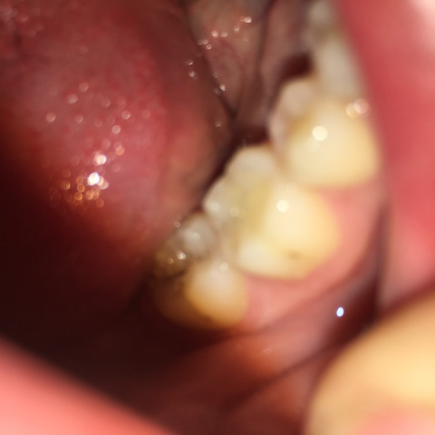 schwarze Punkte an 2 Zähnen - (Zähne, Zahnarzt, bohren)
