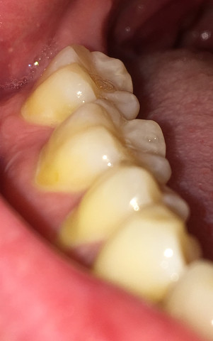 Zahne Gelblich Dentin Vermutlich Durch Starkes Zahneputzen Oder Knirschen Ist Das Jetzt Sehr Schlimm Fur Die Zahne Gesundheit Und Medizin Zahnmedizin Zahneknirschen Zahne Gelblich Dentin Vermutlich Durch Starkes Zahneputzen Oder Knirschen Ist Das Jetzt Sehr Schlimm Fur Die Zahne Gesundheit Und Medizin Zahnmedizin Zahneknirschen