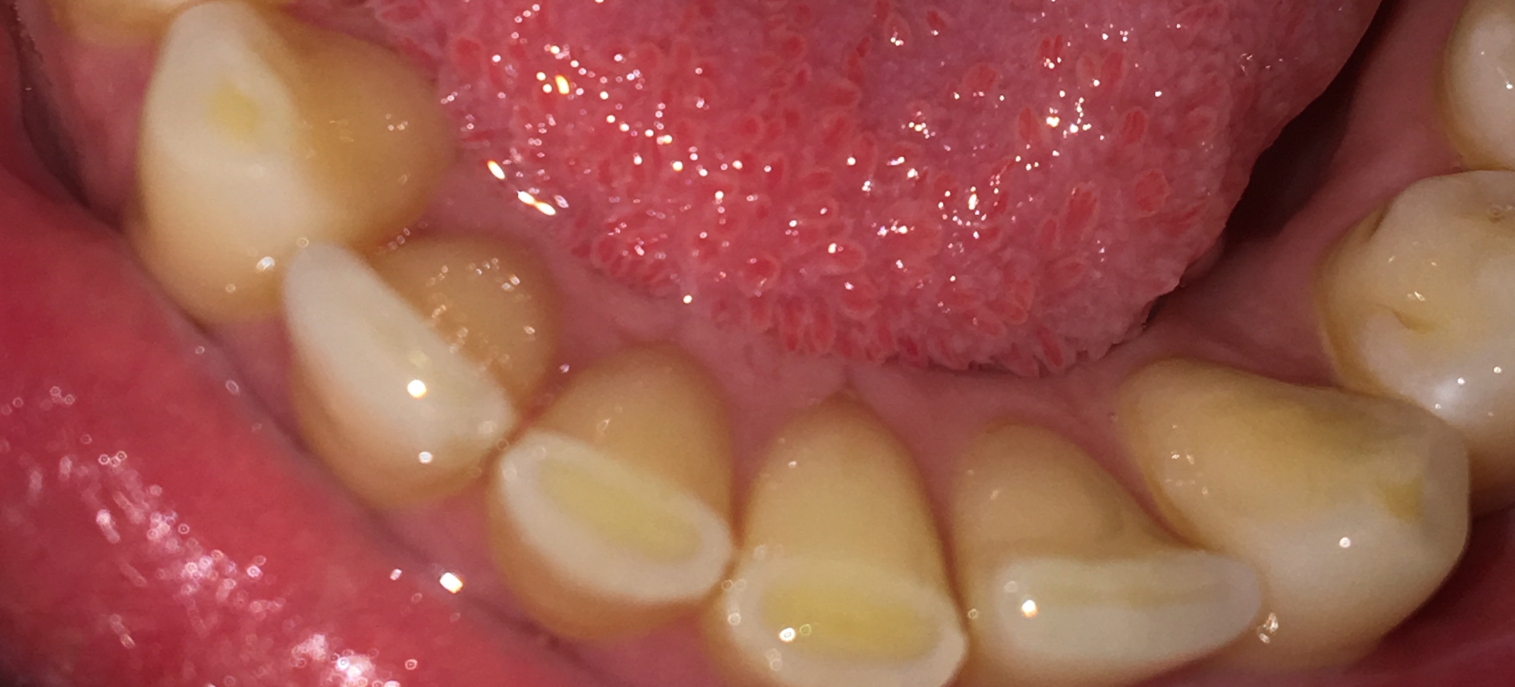 Ist Es Schlimm Wenn Ein Stück Zahn Abbricht Zähne gelblich (Dentin, vermutlich durch starkes Zähneputzen oder