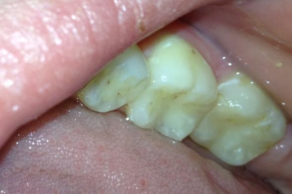 Flecken auf zähnen - (Zähne, Zahnspange)