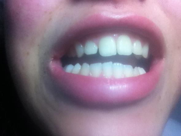 Meine Zähne - (Zähne, Zahnspange, schiefe Zähne)