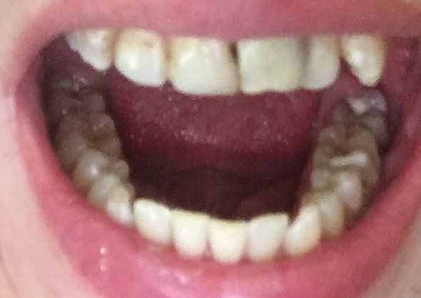 Zähne gegen was tun schlechte Karies selber