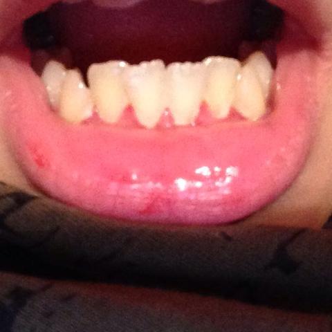 Zahne Wackeln Kann Jemand Helfen Zahnarzt Mund Zahne Wackeln Kann Jemand Helfen Zahnarzt Mund