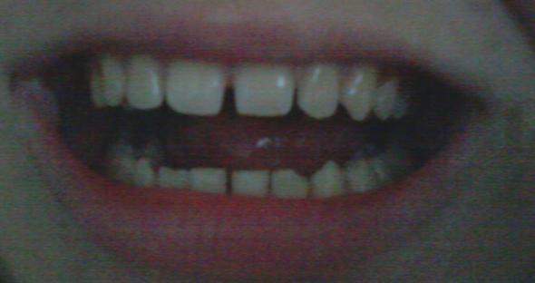 Meine Zähne - (Zähne, Zahnarzt)
