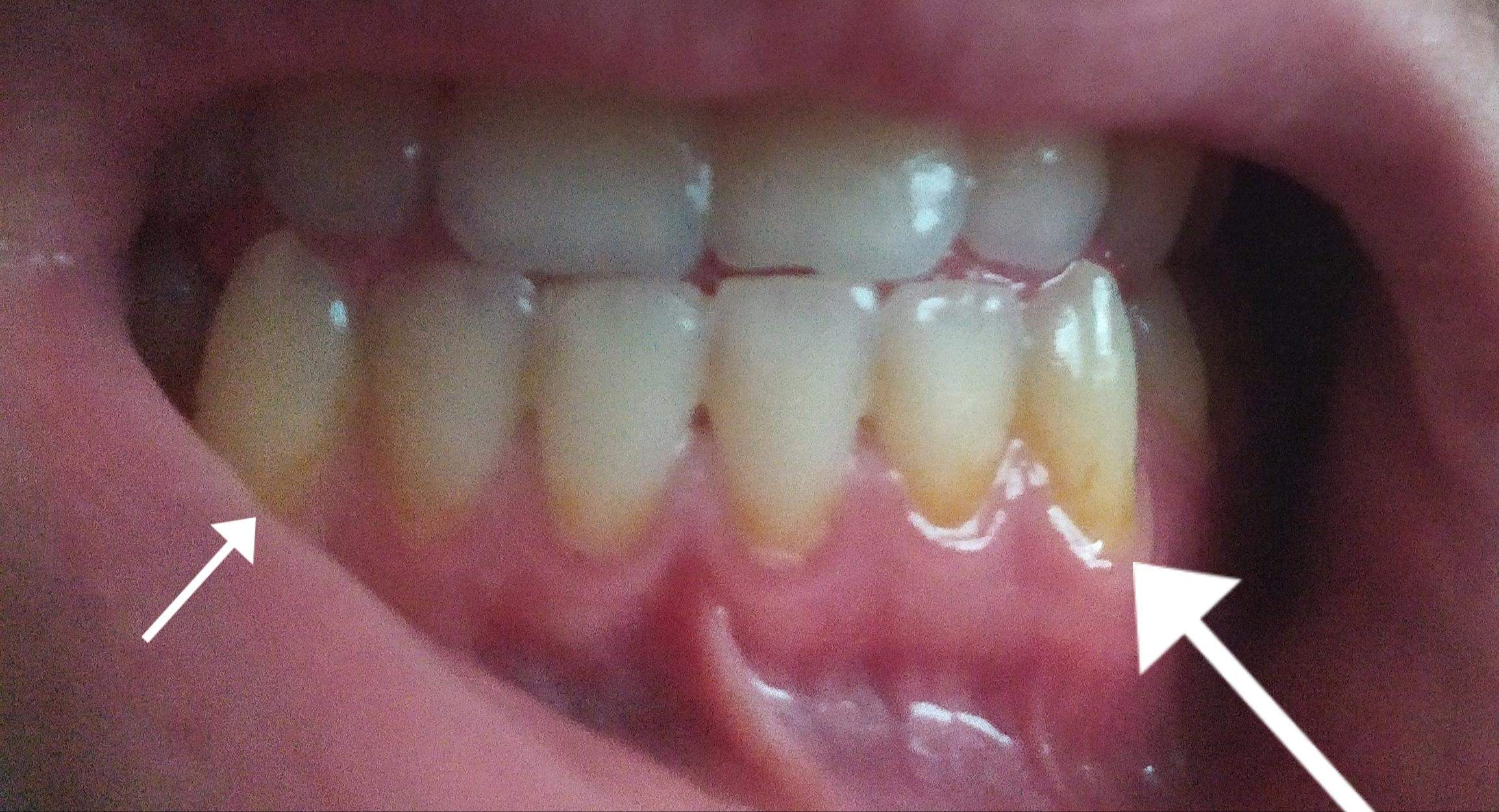 Zahn bildet plötzlich gelbung in der nähe Zahnfleisches? (Gesundheit und Medizin, Zähne Zahn bildet plötzlich gelbung in der nähe Zahnfleisches? (Gesundheit und Medizin, Zähne