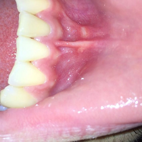 Was Kann Ich Gegen Schmerzen Am Zahnfleisch Nach Einer Zahnreinigung Machen Gesundheit Und Medizin Gesundheit Medizin Was Kann Ich Gegen Schmerzen Am Zahnfleisch Nach Einer Zahnreinigung Machen Gesundheit Und Medizin Gesundheit Medizin