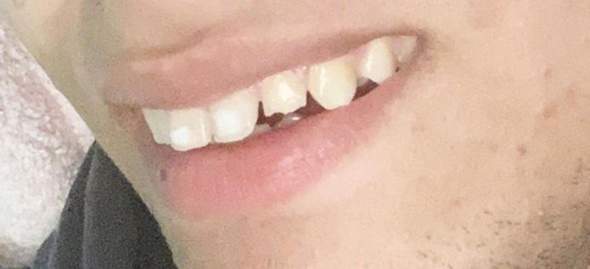 Zahn gebrochen was passiert?