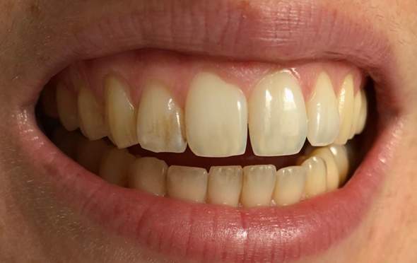 Zahn Gelb Braun Verfarbt Wie Zerkratzt Zahnschmelz Karies Zahne Zahnmedizin Zahnstein