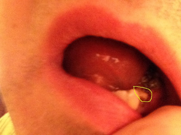 Zahn gezogen - (Gesundheit, Zähne)