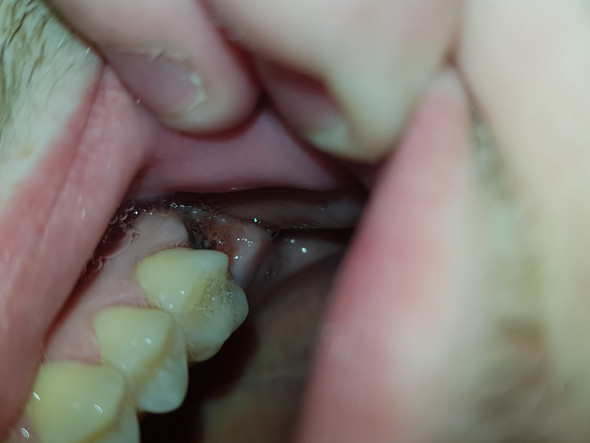 Gezogen schmerzen backenzahn Zahn gezogen