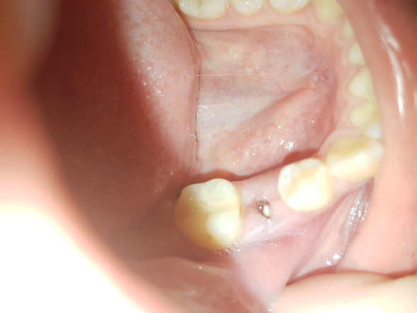 Gezogener zahn - (Zähne, weißer Punkt)