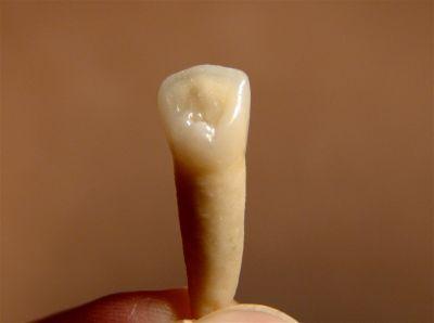 Zahn Mit Wurzel Rausgefallen Zahne