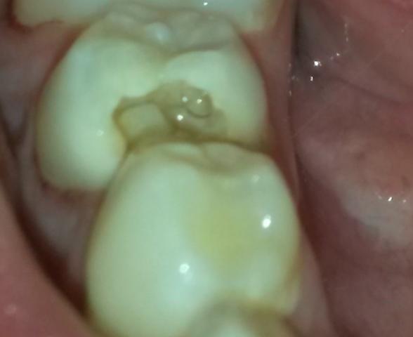 Der Zahn in der totalen - (Schmerzen, Zähne, Zahnarzt)