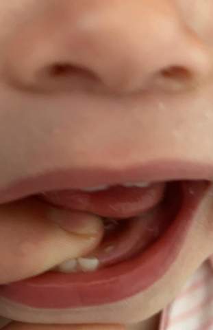 Zahn Wachst In Zweiter Reihe Beim Kind 1 5 Jahre Alt Zum Zahnarzt Gehen Kinder Zahne Zahn Wachst In Zweiter Reihe Beim Kind 1 5 Jahre Alt Zum Zahnarzt Gehen Kinder Zahne