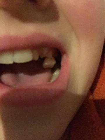 Zahn Ziehen Gesundheit Und Medizin Zahne Zahn Ziehen Gesundheit Und Medizin Zahne