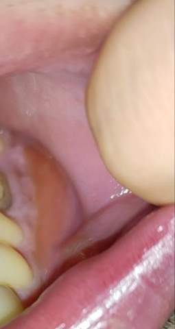 Zahnabszess Behandlung?