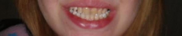 gelbe zähne - (Zähne, Zahnarzt, gelbe Zähne)