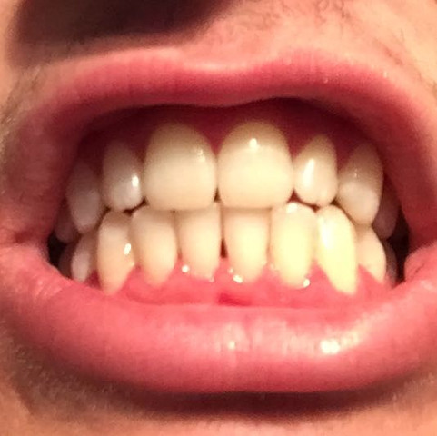 Bild meiner Zähne nach Zahnartztbesuch - (Gesundheit und Medizin, Arzt, Zahnarzt)
