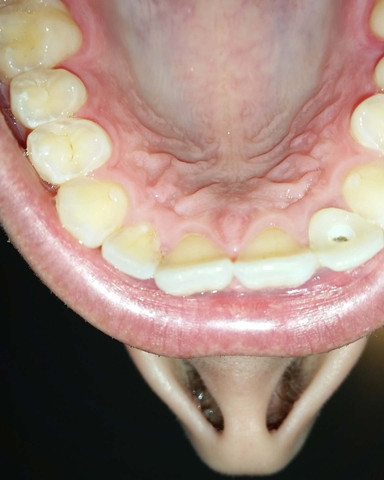 Provisorium - (Zähne, zahnwurzel)