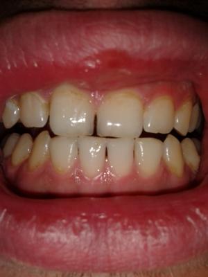Zahn - (Zahnarzt, Zahnfleisch, Parodontitis)
