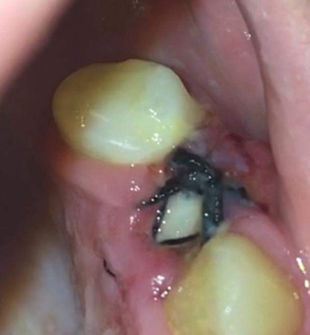 Wundheilung nach einer Zahnextraktion: Zeitrahmen für das Schließen des Lochs Wundheilung nach einer Zahnextraktion: Zeitrahmen für das Schließen des Lochs